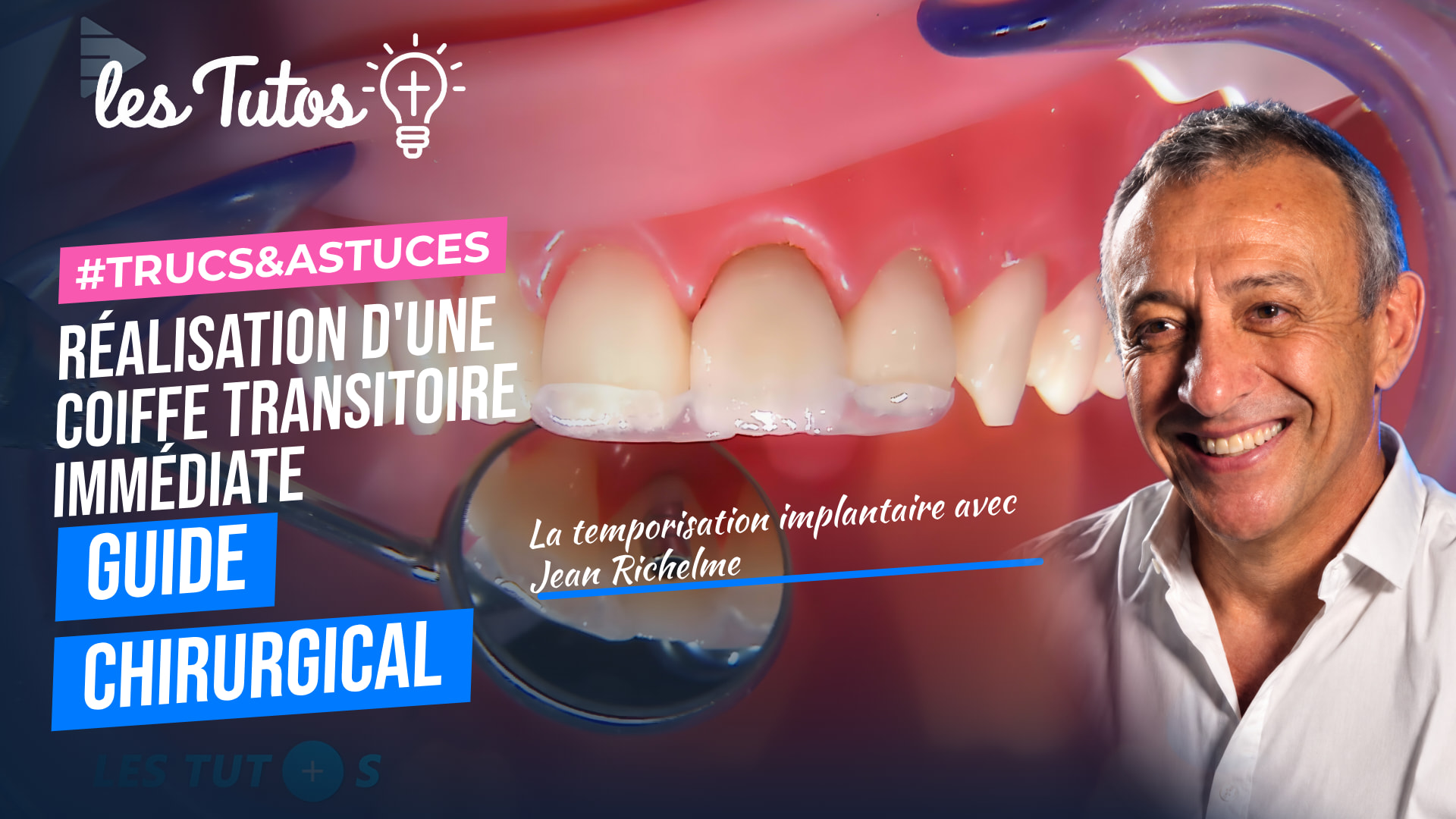 Réalisation d'une coiffe transitoire immédiate à l'aide du guide chirurgical (Tuto, saison 1 épisode 16) : Étapes de réalisation d'une coiffe…