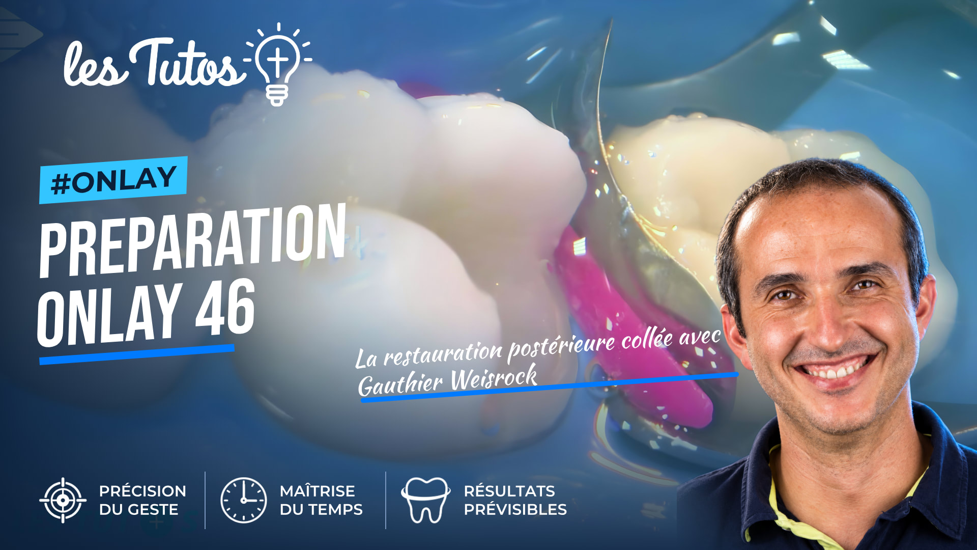 Preparation onlay 46 (Tuto, saison 2 épisode 18) : Tutoriel du Dr Gauthier Weisrock : les étapes d'une restauration postérieure collée (46) par…