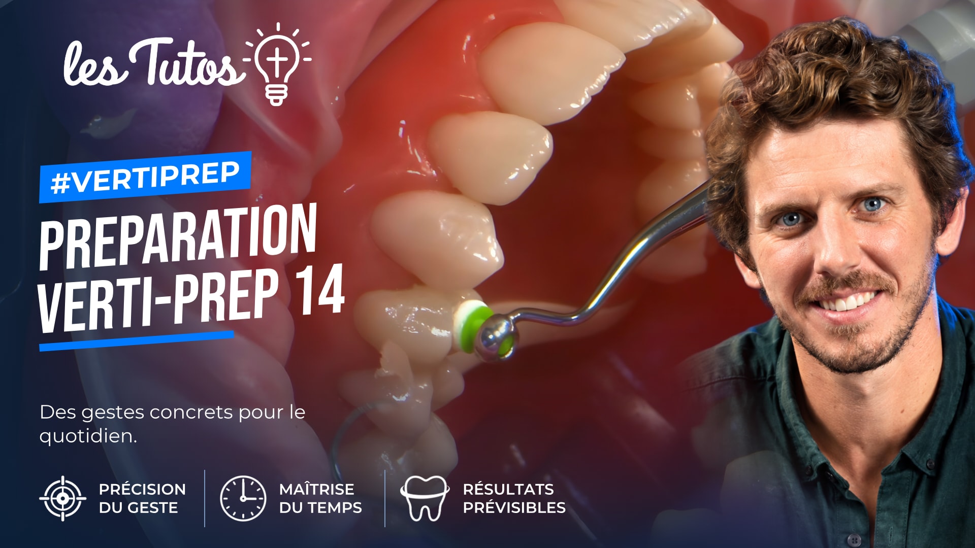 Preparation verti-prep 14 (Tuto, saison 2 épisode 20) : Démonstration muette du Dr Hugues de Belenet : une préparation Verti-Prep sur la prémolaire…