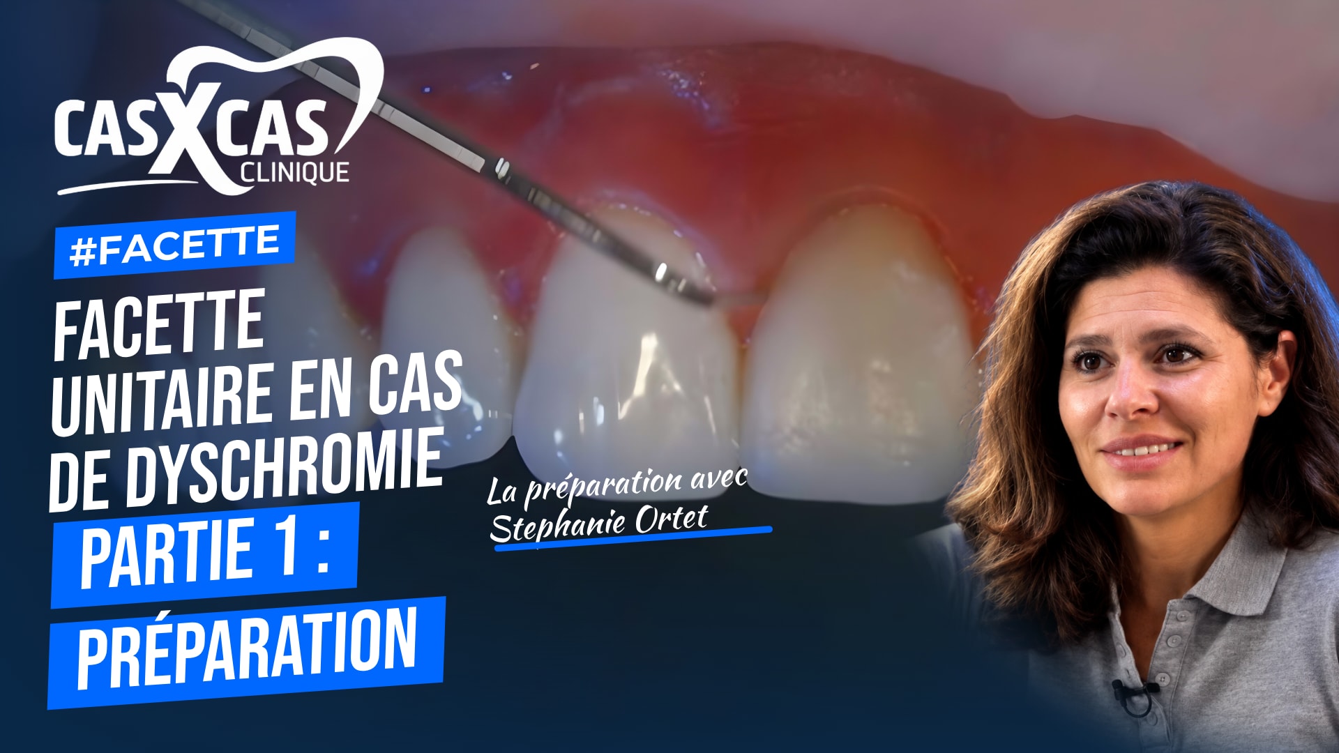 Facette unitaire en cas de dyschromie partie 1 : préparation (Cas par Cas, saison 1 épisode 1) : Le Dr Stéphanie Ortet présente les techniques de…