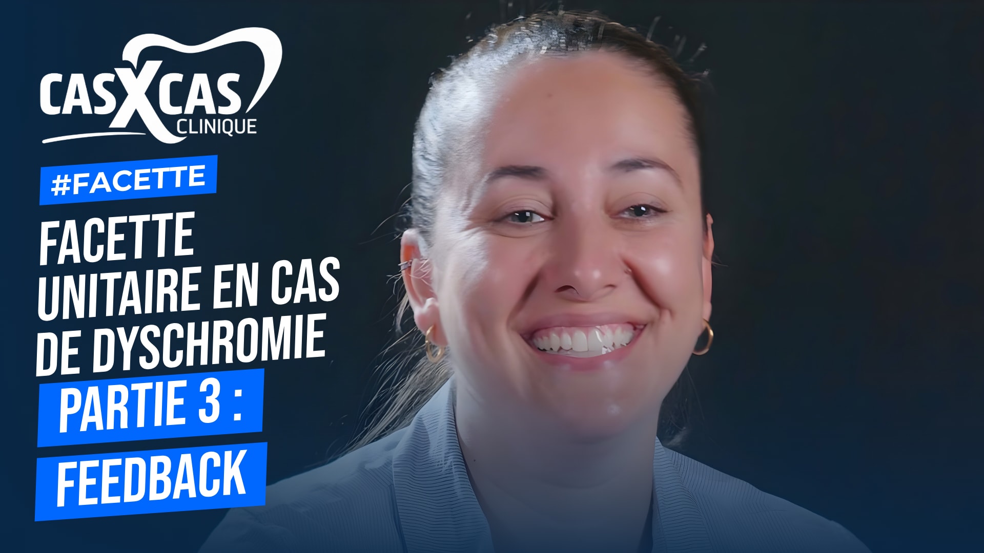 Facette unitaire en cas de dyschromie partie 3 : feedback (Cas par Cas, saison 1 épisode 3) : Dans la conclusion de cette série sur les facettes…