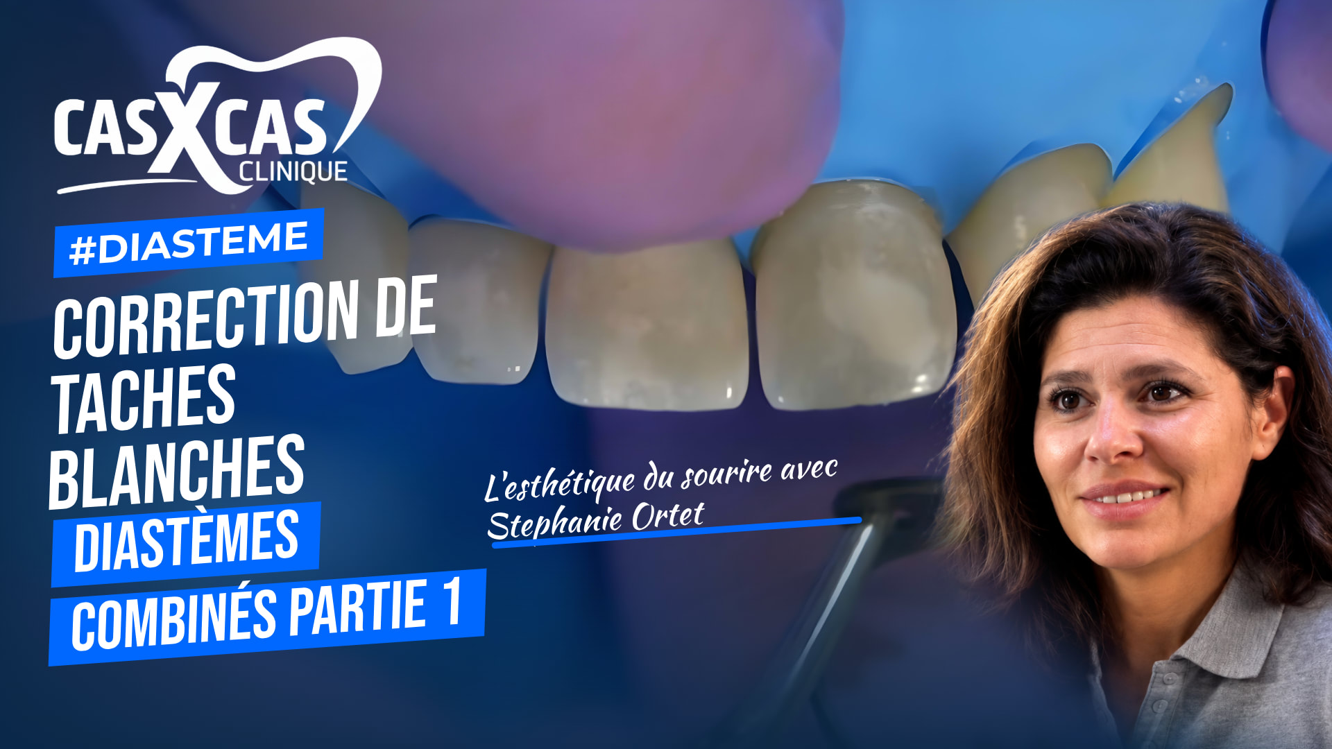 Cas clinique : correction de taches blanches et diastèmes combinés partie 1 (Cas par Cas, saison 1 épisode 4) : Le Dr Stéphanie Ortet aborde la…