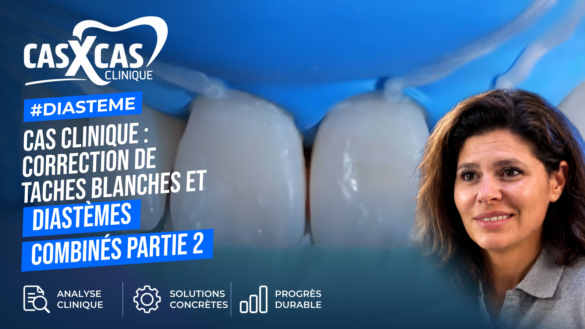 Cas clinique : correction de taches blanches et diastèmes combinés partie 2 (Cas par Cas, saison 1 épisode 5) : Le Dr Stéphanie Ortet aborde la…