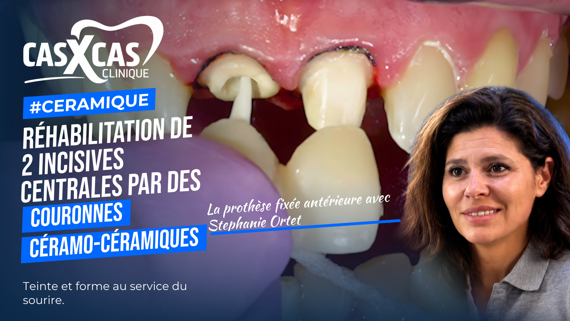 Cas clinique : réhabilitation de 2 incisives centrales par des couronnes céramo-céramiques (Cas par Cas, saison 1 épisode 6)