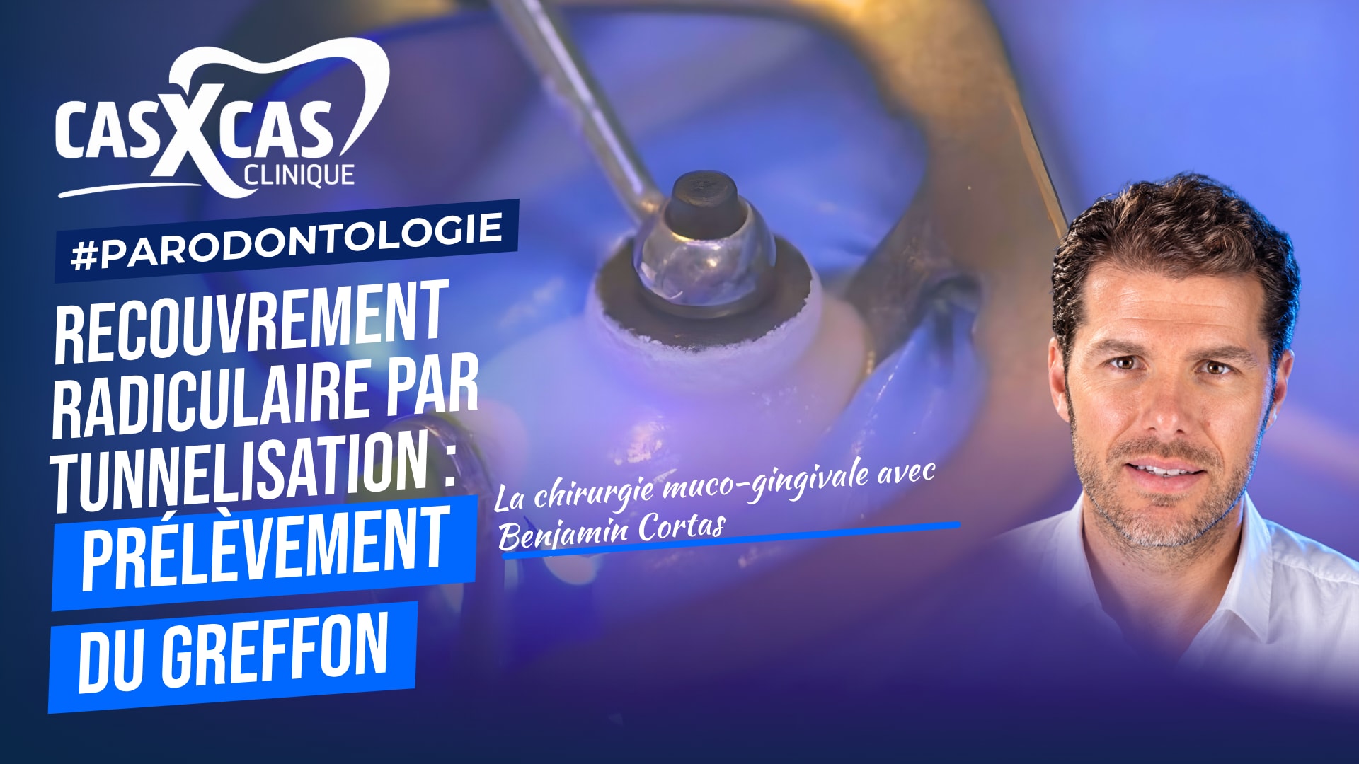 Chirurgie de recouvrement radiculaire par tunnelisation : prélèvement du greffon (Cas par Cas, saison 2 épisode 2) : Deuxième partie muette du Dr…