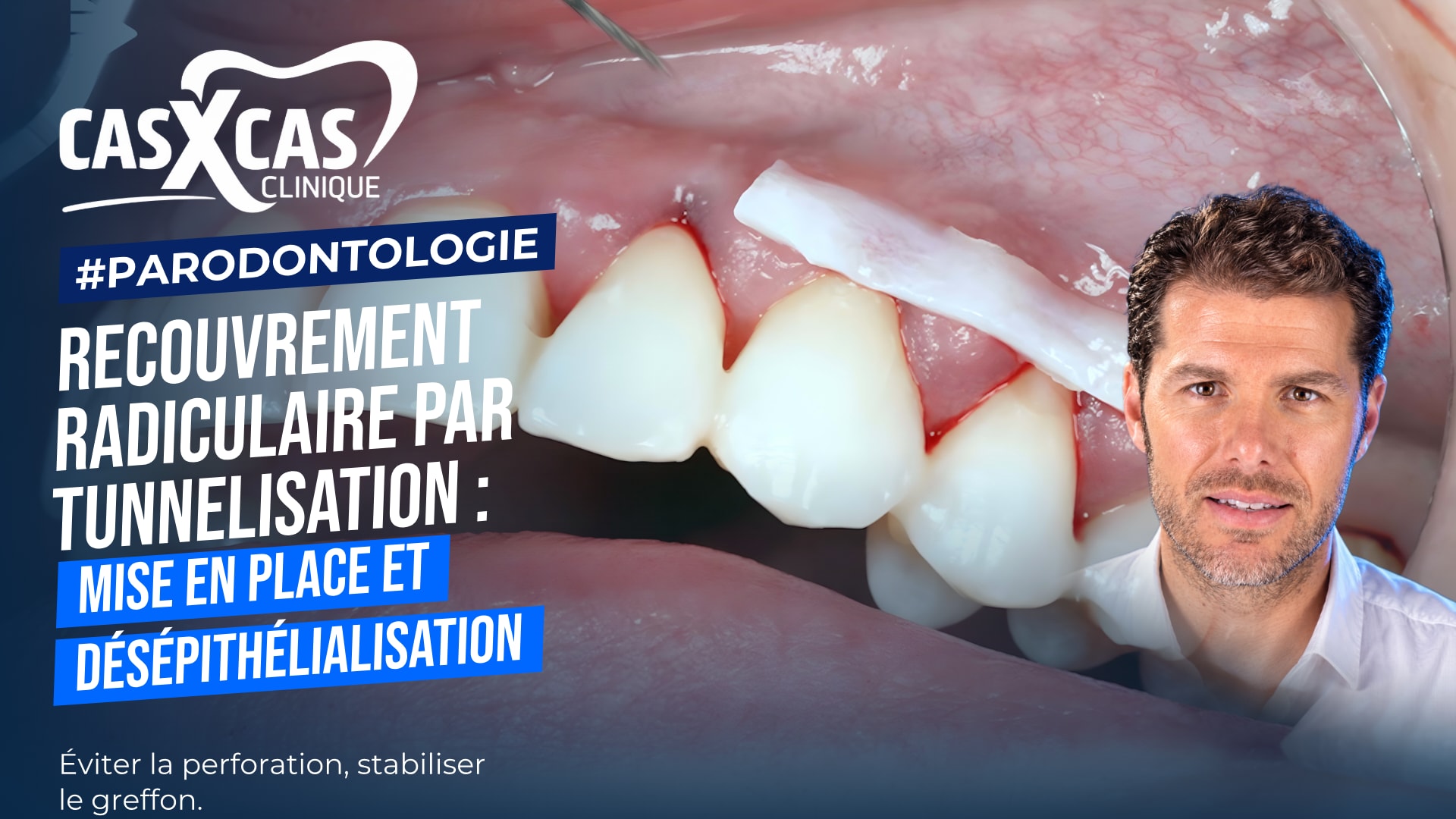 Chirurgie de recouvrement radiculaire par tunnelisation : mise en place et désépithélialisation (Cas par Cas, saison 2 épisode 3)