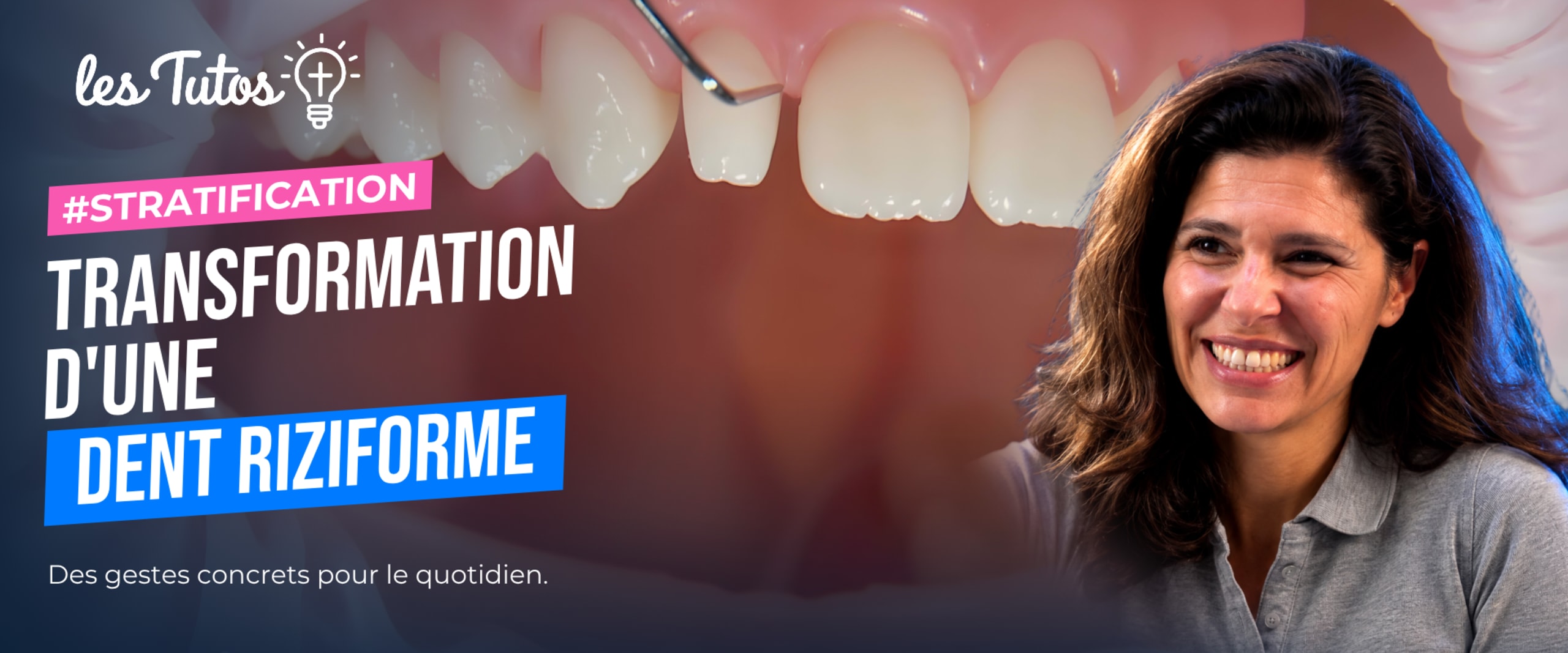 Transformation d'une dent riziforme (Tuto, saison 1 épisode 25) : Transformation d'une latérale riziforme par stratification en composite