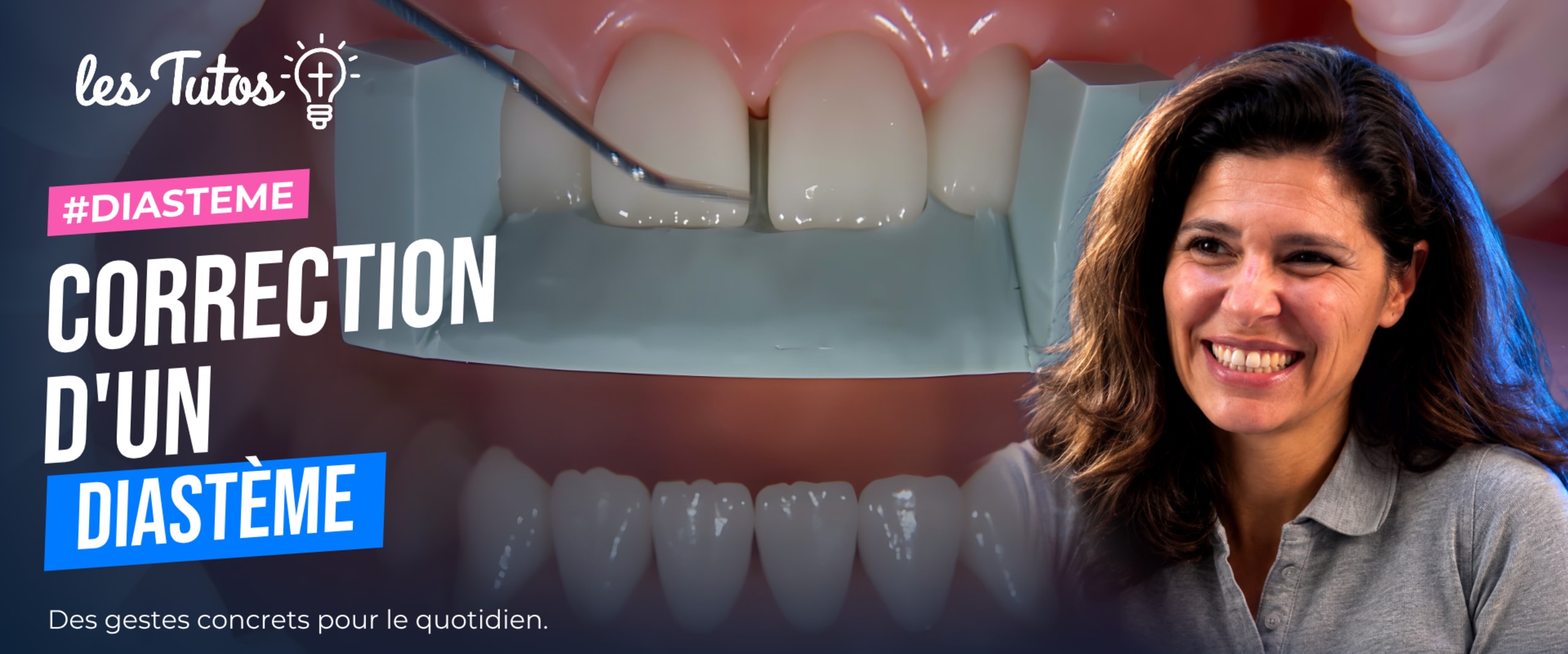 Correction d'un diastème (Tuto, saison 1 épisode 26) : Le Dr Stéphanie Ortet démontre dans ce tutoriel les étapes précises pour la correction d'un…