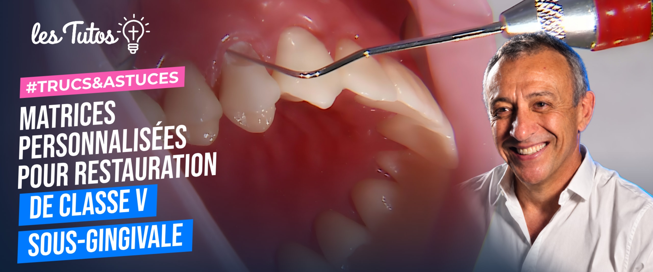 Matrices personnalisées pour restauration de classe v sous-gingivale (Tuto, saison 1 épisode 2) : Mise en place d'une matrice personnalisée pour un…