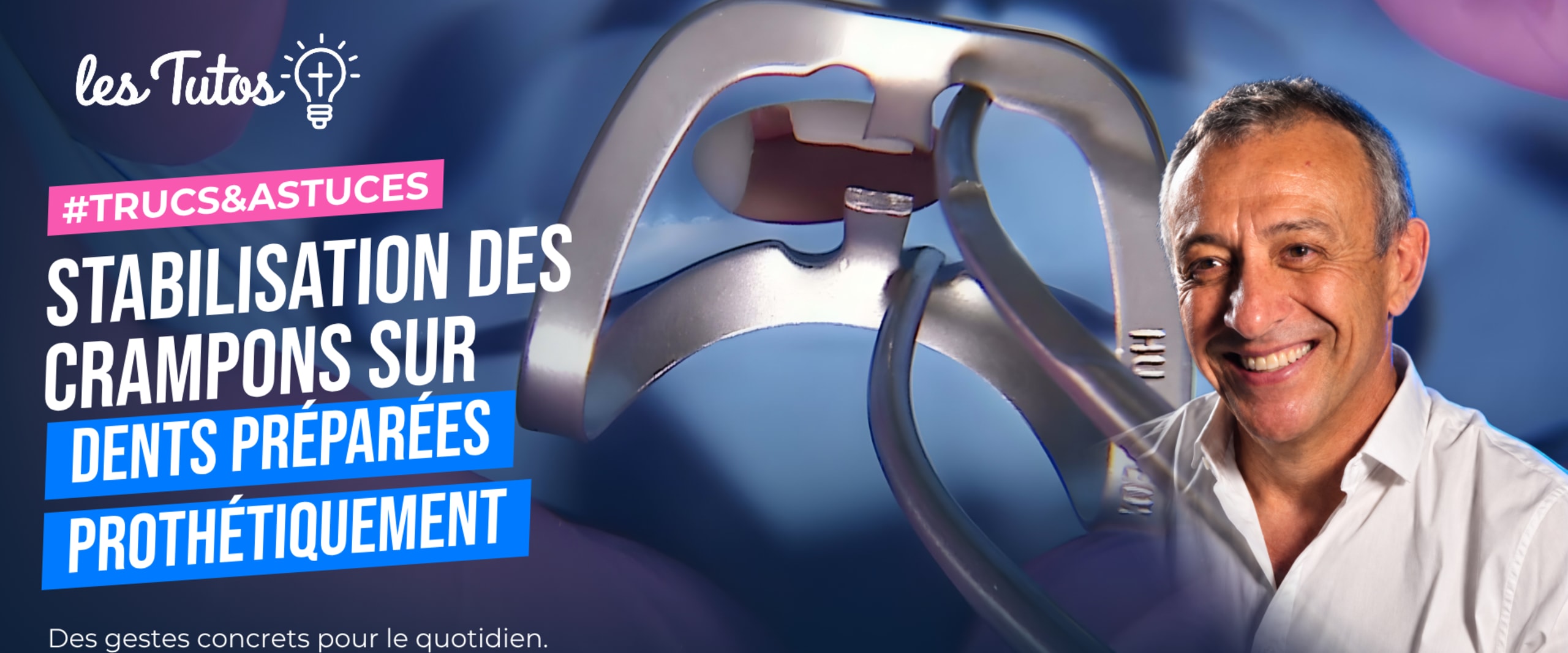 Stabilisation des crampons sur dents préparées prothétiquement (Tuto, saison 1 épisode 3) : Maintien des crampons dans des situations cliniques…