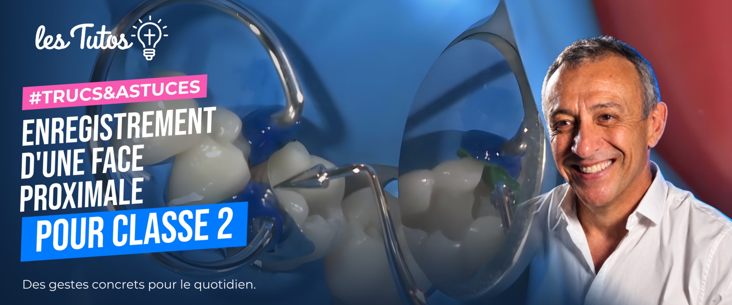 Enregistrement d'une face proximale pour classe 2 (Tuto, saison 1 épisode 4) : Enregistrement d'une crête marginale afin d'en faciliter la…