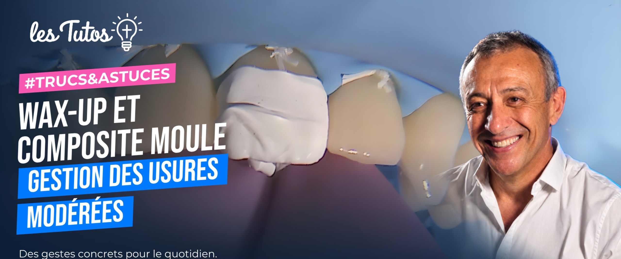 Wax-up et composite moule gestion des usures modérées (Tuto, saison 1 épisode 6) : Restauration de bords libres usés à l'aide de composite moulé