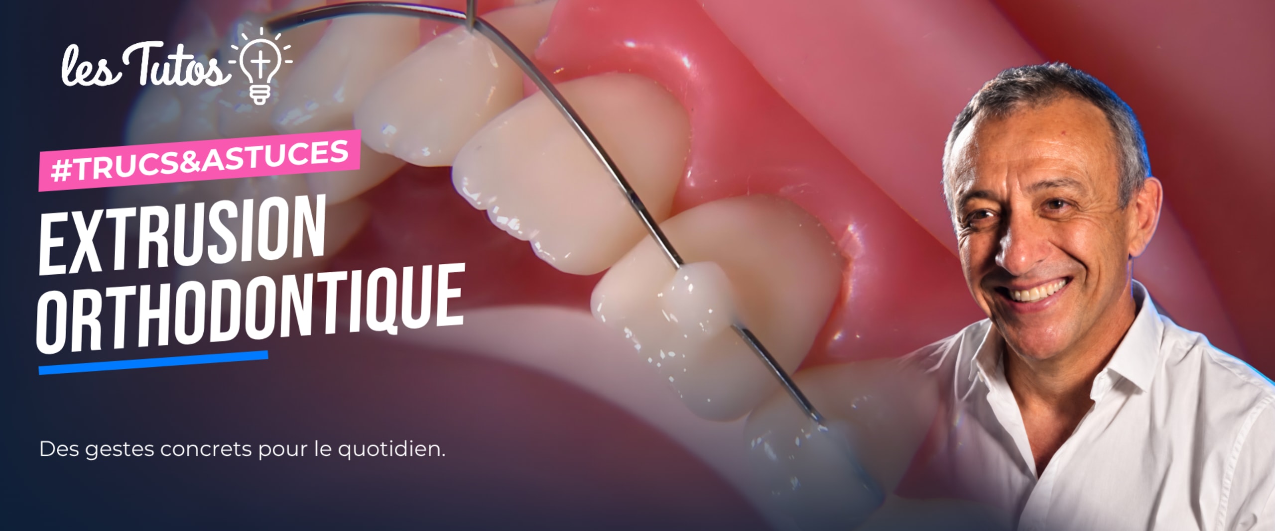 Extrusion orthodontique (Tuto, saison 1 épisode 8) : Utilisation de fil d'orthodontie pour permettre l'extrusion d'une incisive latérale