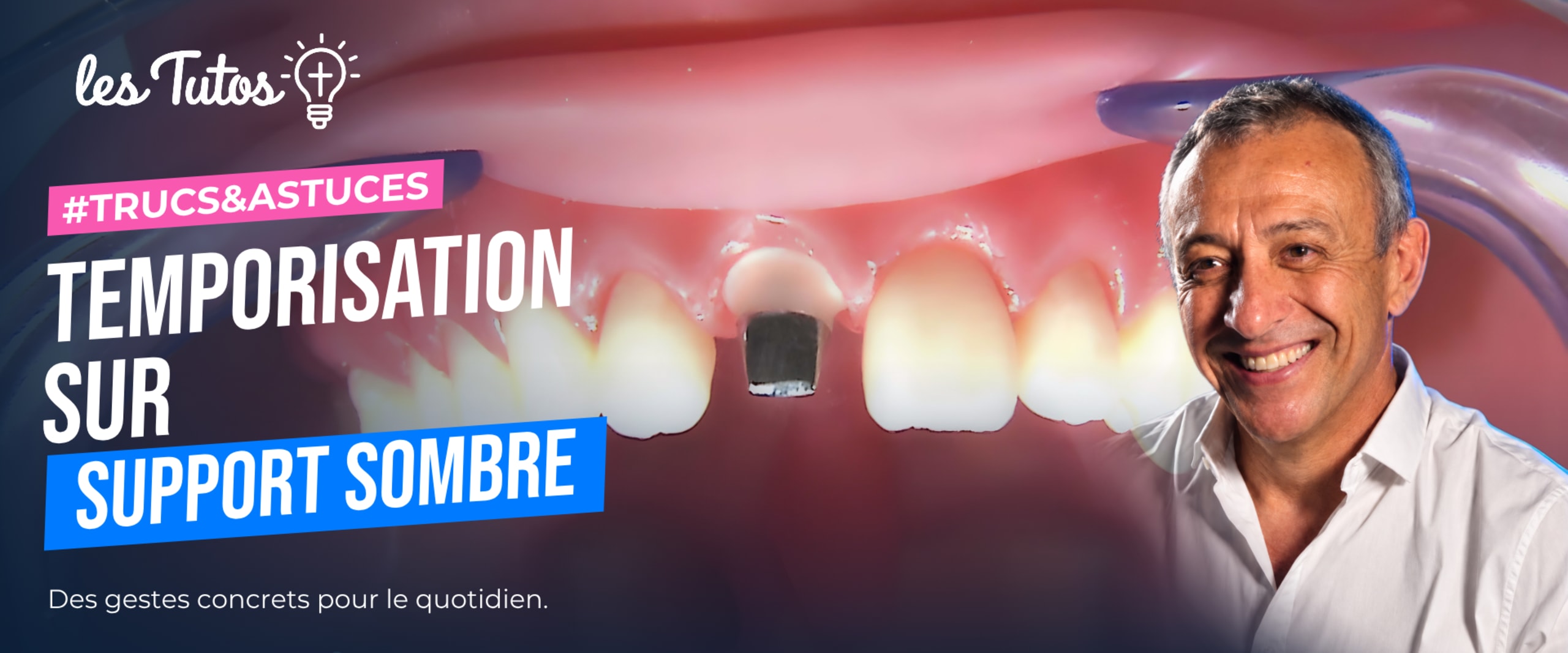 Temporisation sur support sombre (Tuto, saison 1 épisode 12) : Réalisation de provisoire en résine composite sur support métallique