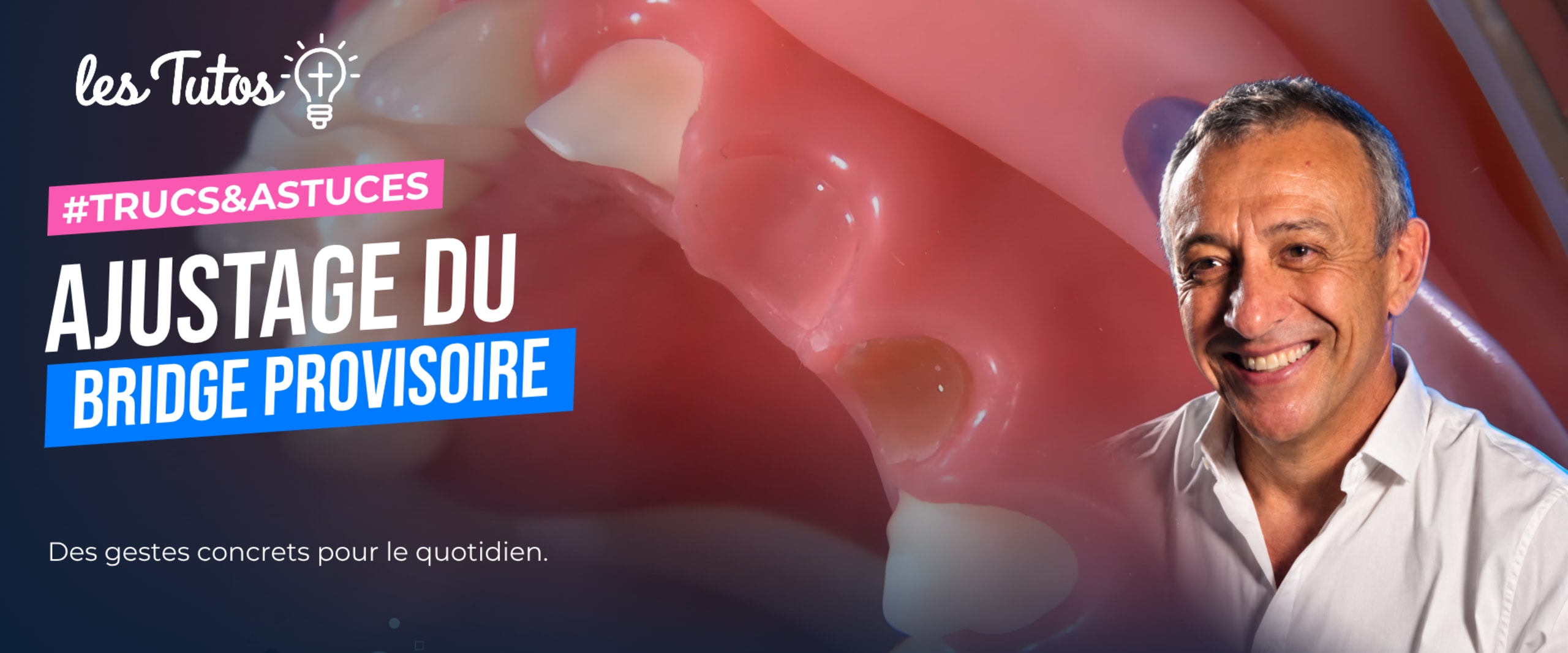 Ajustage du bridge provisoire (Tuto, saison 1 épisode 13) : Le Dr Jean Richelme explique l'ajustage précis d'un bridge provisoire dans cette vidéo…