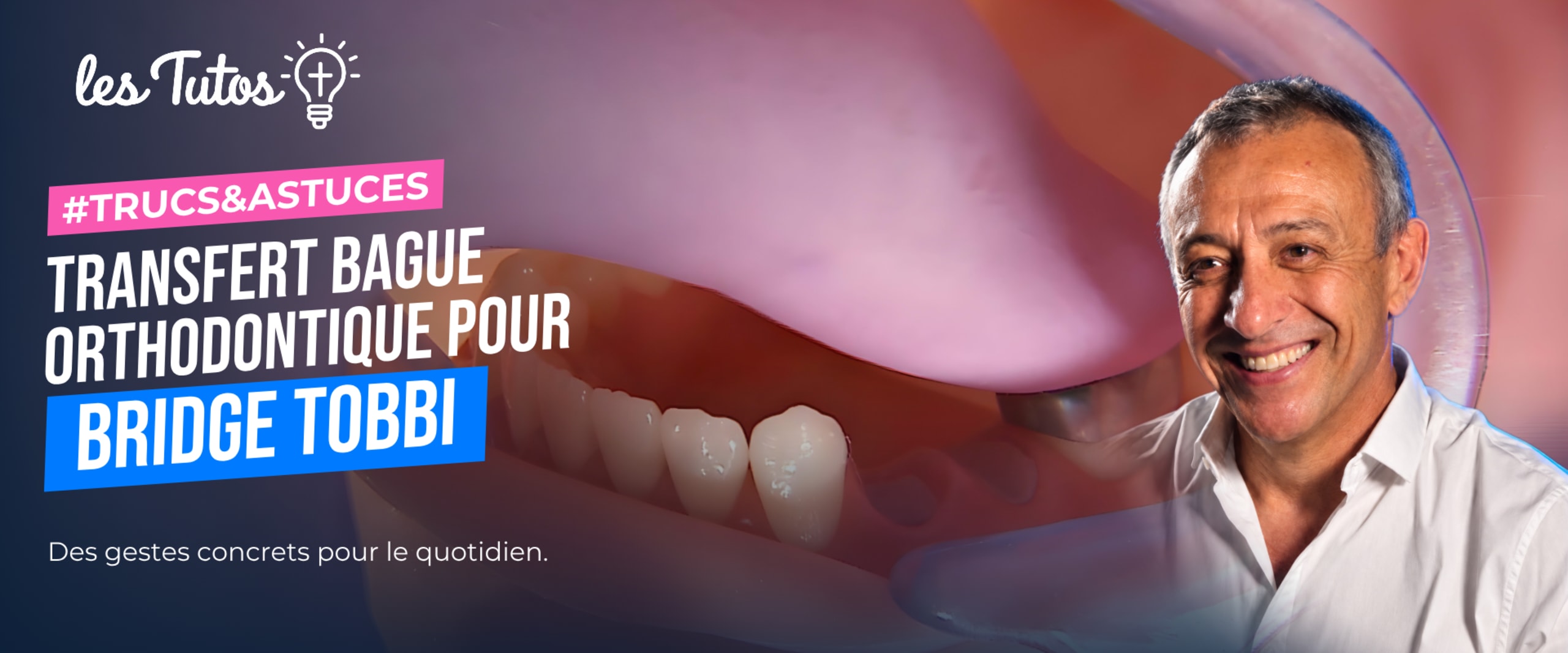 Transfert bague orthodontique pour bridge tobbi (Tuto, saison 1 épisode 15) : Transfert de bague orthodontique pour bridge TOBBI