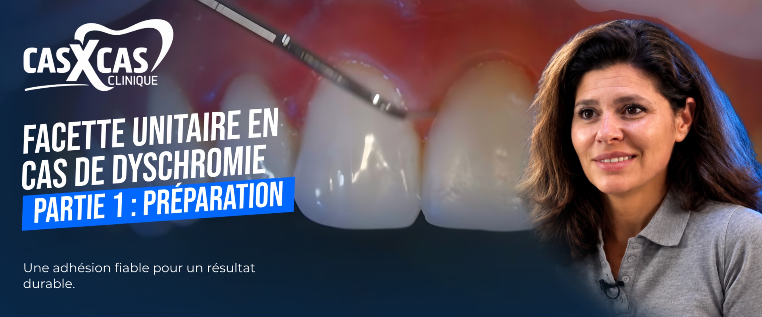 Facette unitaire en cas de dyschromie partie 1 : préparation (Cas par Cas, saison 1 épisode 1) : Le Dr Stéphanie Ortet présente les techniques de…