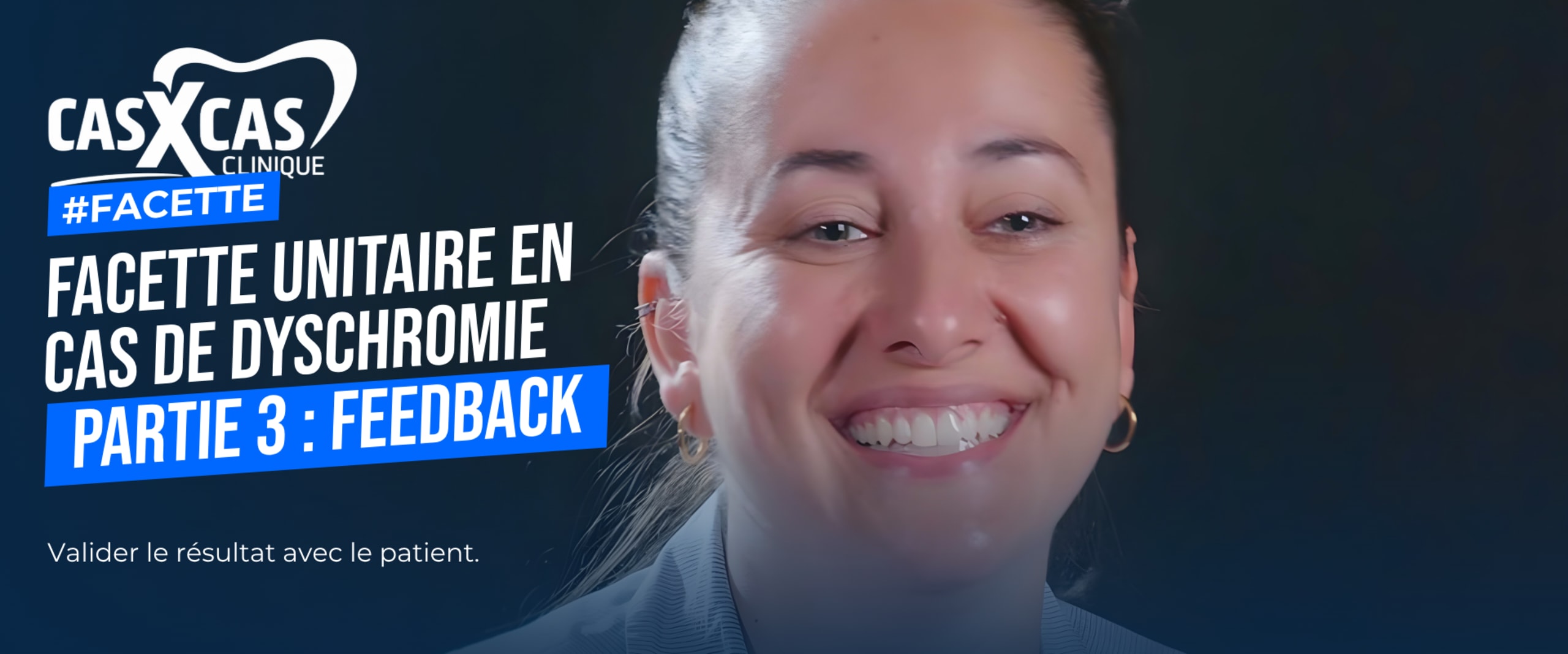 Facette unitaire en cas de dyschromie partie 3 : feedback (Cas par Cas, saison 1 épisode 3) : Dans la conclusion de cette série sur les facettes…