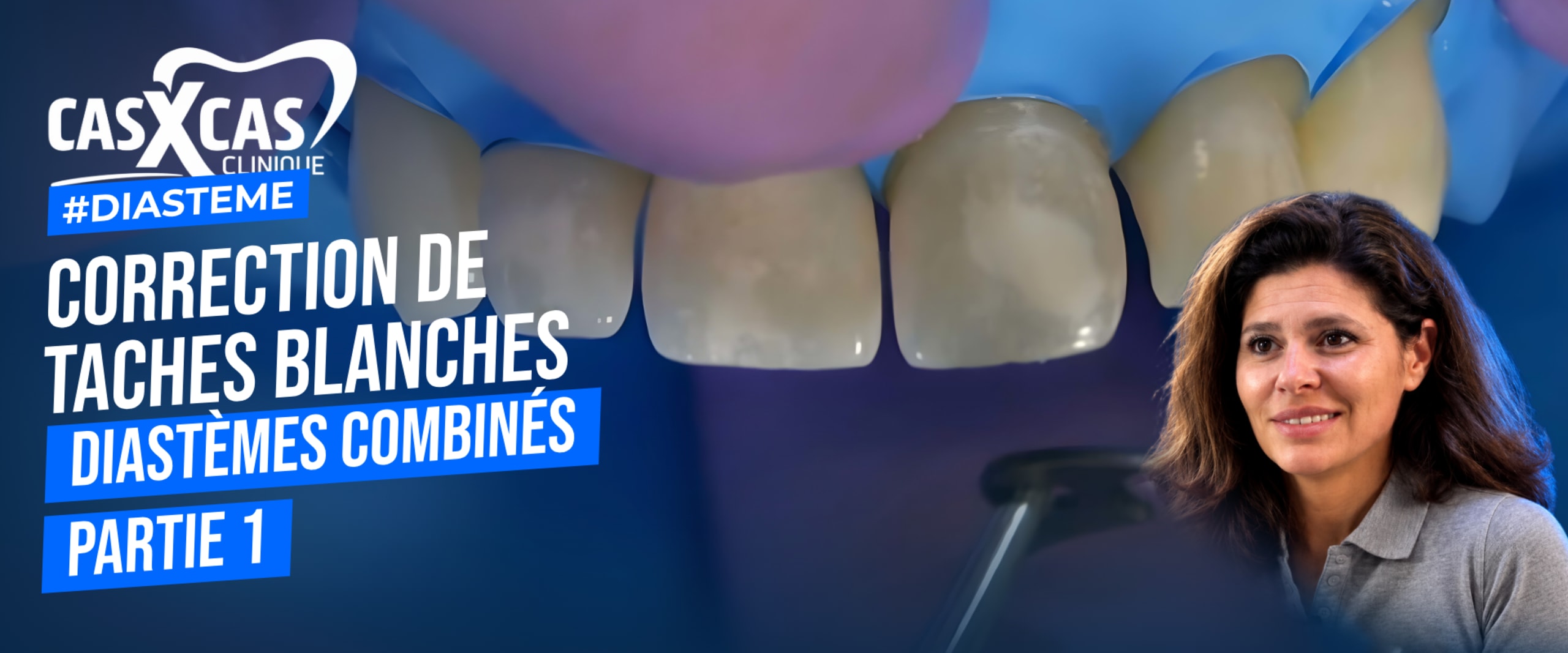 Cas clinique : correction de taches blanches et diastèmes combinés partie 1 (Cas par Cas, saison 1 épisode 4) : Le Dr Stéphanie Ortet aborde la…