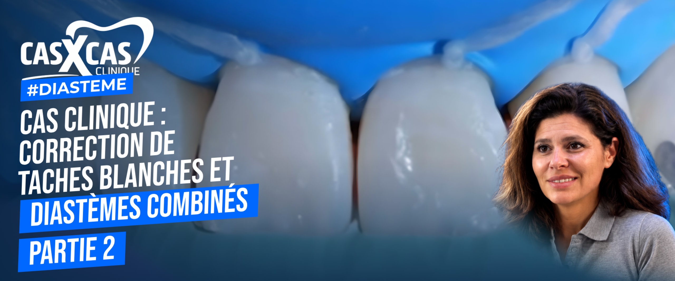 Cas clinique : correction de taches blanches et diastèmes combinés partie 2 (Cas par Cas, saison 1 épisode 5) : Le Dr Stéphanie Ortet aborde la…