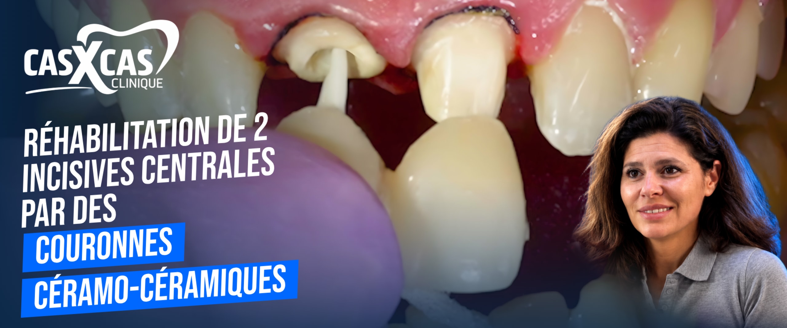 Cas clinique : réhabilitation de 2 incisives centrales par des couronnes céramo-céramiques (Cas par Cas, saison 1 épisode 6)