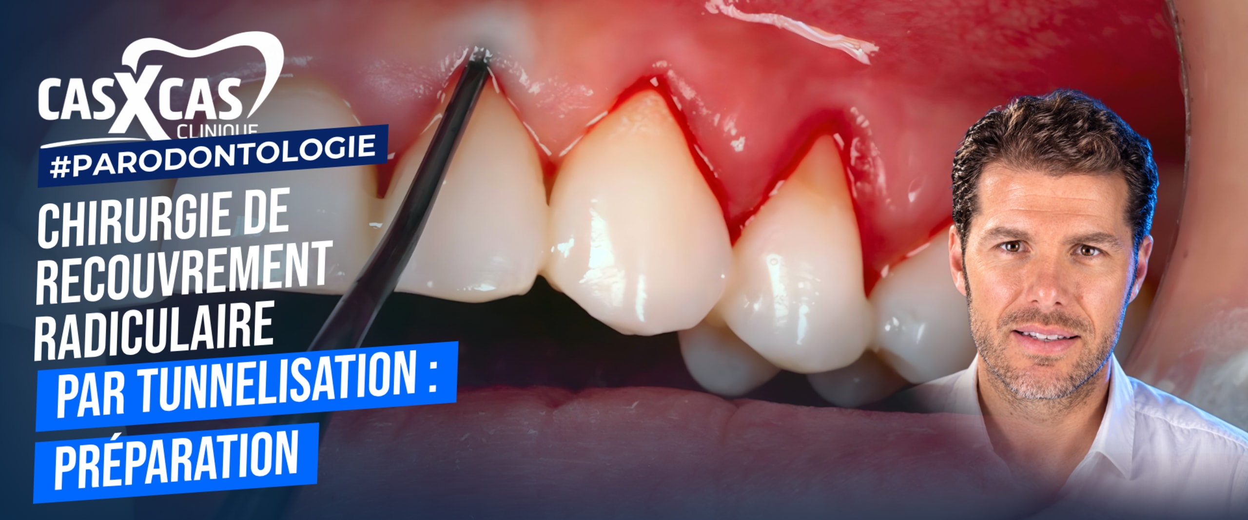 Chirurgie de recouvrement radiculaire par tunnelisation : préparation (Cas par Cas, saison 2 épisode 1) : Démonstration muette du Dr Benjamin Cortas…