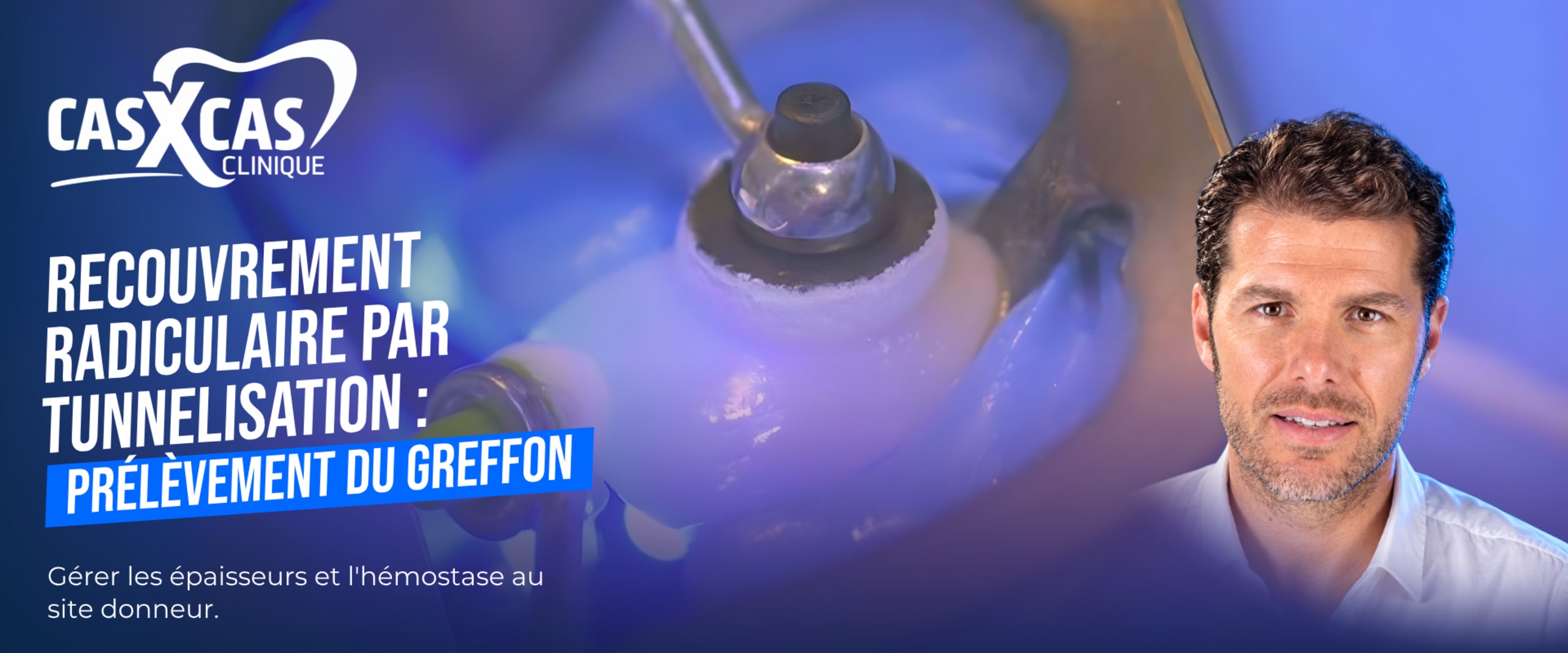 Chirurgie de recouvrement radiculaire par tunnelisation : prélèvement du greffon (Cas par Cas, saison 2 épisode 2) : Deuxième partie muette du Dr…