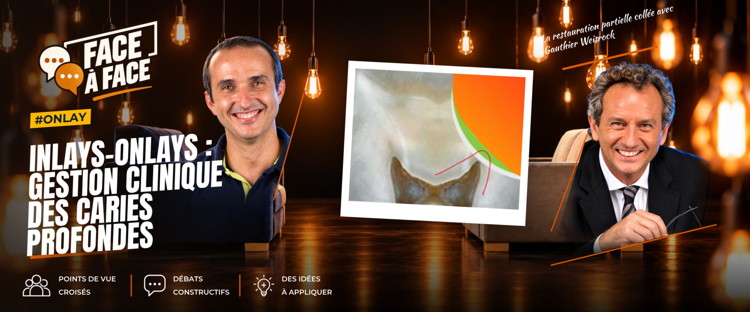Inlays-onlays : gestion clinique des caries profondes (Face à Face, saison 1 épisode 47) : Inlays-Onlays : gestion clinique des caries profondes…