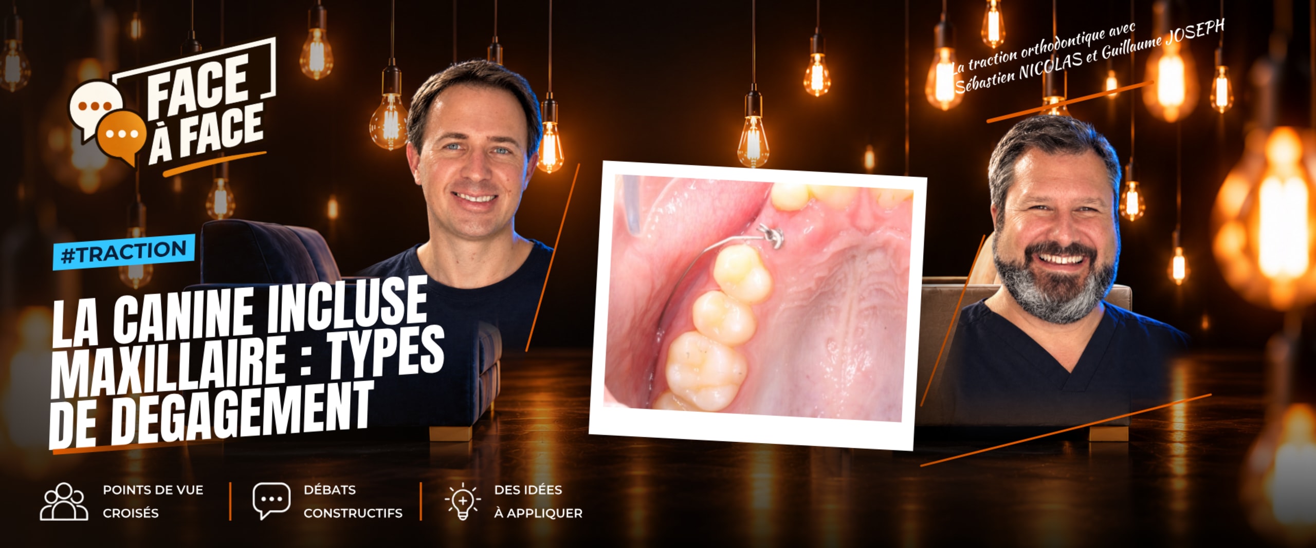 La canine incluse maxillaire : types de degagement