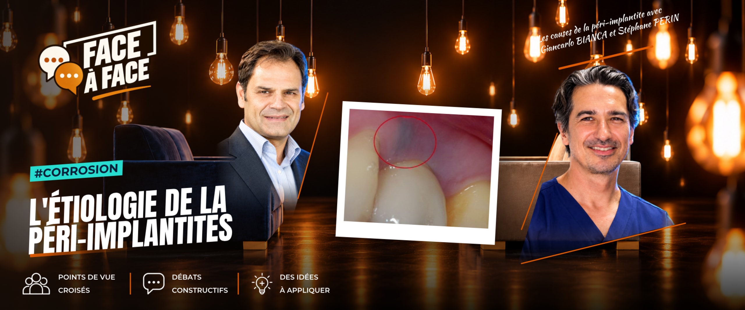 L'étiologie de la péri-implantites (Face à Face, saison 2 épisode 23) : L'étiologie de la péri-implantite au-delà du seul facteur bactérien : le…