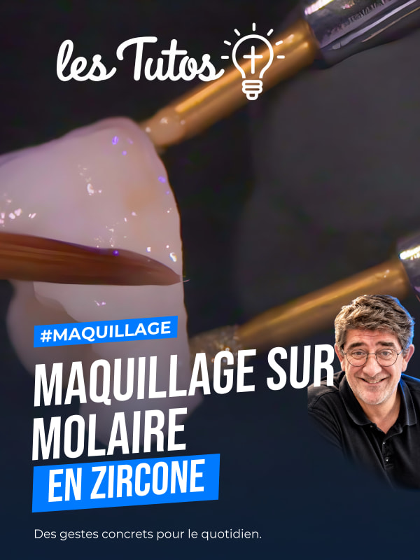 Maquillage sur molaire en zircone (Tuto, saison 2 épisode 28) : Démonstration technique muette de Benoit Capelle : le maquillage d'une molaire en…