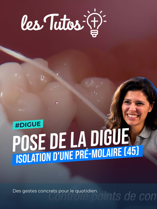 Pose de la digue isolation d'une pré-molaire (45) (Tuto, saison 1 épisode 24) : Isolation d'une pré-molaire à l'aide d'un champ opératoire