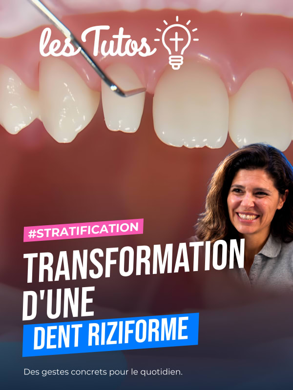 Transformation d'une dent riziforme (Tuto, saison 1 épisode 25) : Transformation d'une latérale riziforme par stratification en composite