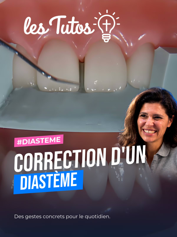 Correction d'un diastème (Tuto, saison 1 épisode 26) : Le Dr Stéphanie Ortet démontre dans ce tutoriel les étapes précises pour la correction d'un…