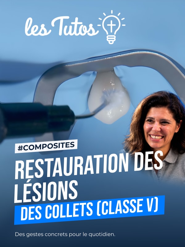 Restauration des lésions des collets (classe v) (Tuto, saison 1 épisode 27) : Restauration de collet en résine composite suite à une lésion