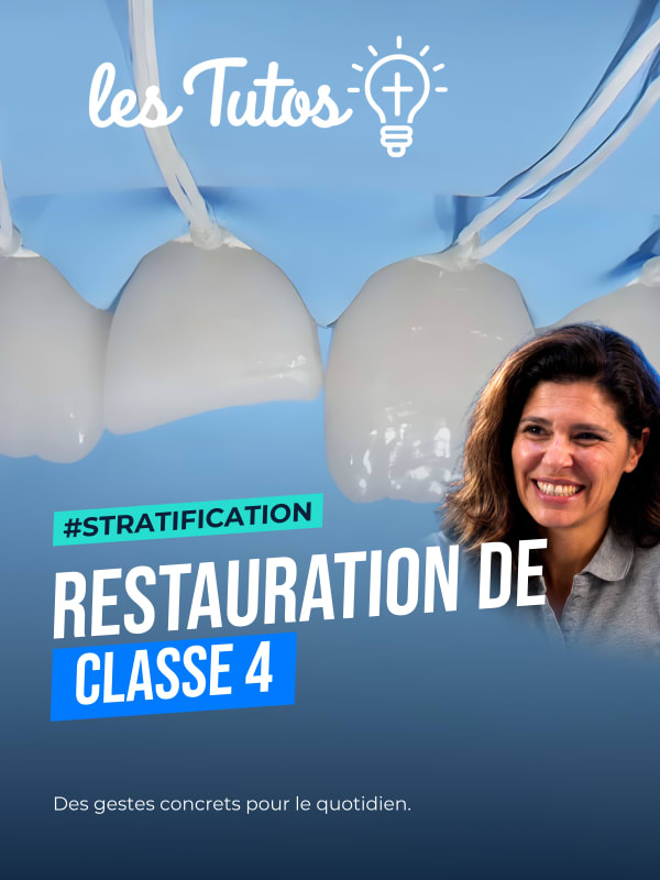 Restauration de classe 4 (Tuto, saison 1 épisode 28) : Restauration d'une centrale fracturée à l'aide de résine composite