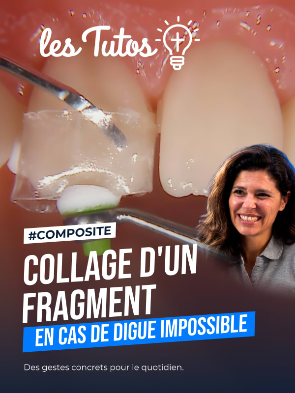 Collage d'un fragment en cas de digue impossible (Tuto, saison 1 épisode 31) : Technique de collage d'un fragment dentaire lorsque la pose d'un…
