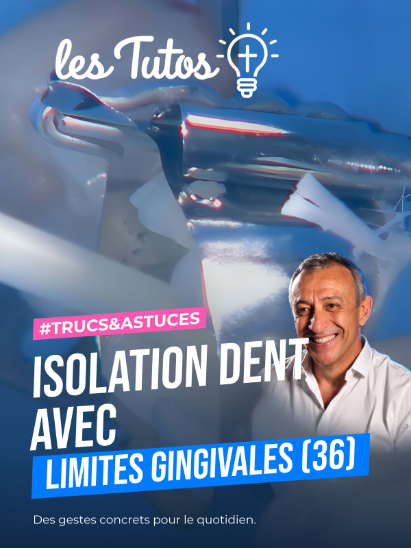 Isolation dent avec limites gingivales (36) (Tuto, saison 1 épisode 1) : Dans cet épisode de "Les tutos", le Dr Jean Richelme démontre…