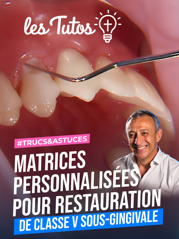 Matrices personnalisées pour restauration de classe v sous-gingivale (Tuto, saison 1 épisode 2) : Mise en place d'une matrice personnalisée pour un…