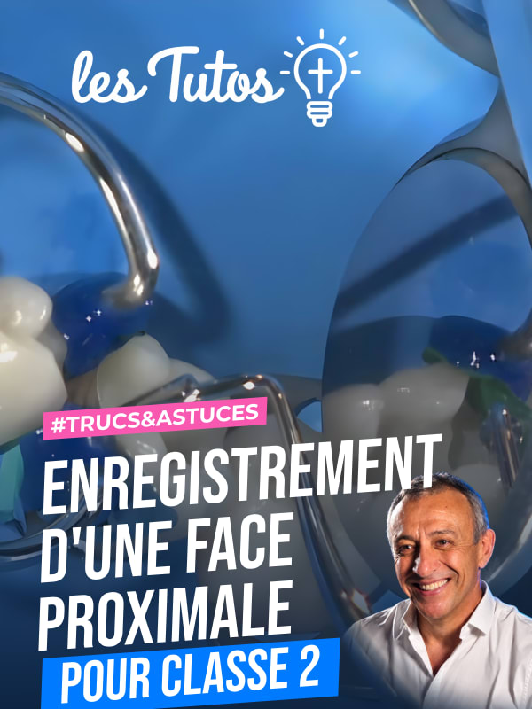 Enregistrement d'une face proximale pour classe 2 (Tuto, saison 1 épisode 4) : Enregistrement d'une crête marginale afin d'en faciliter la…