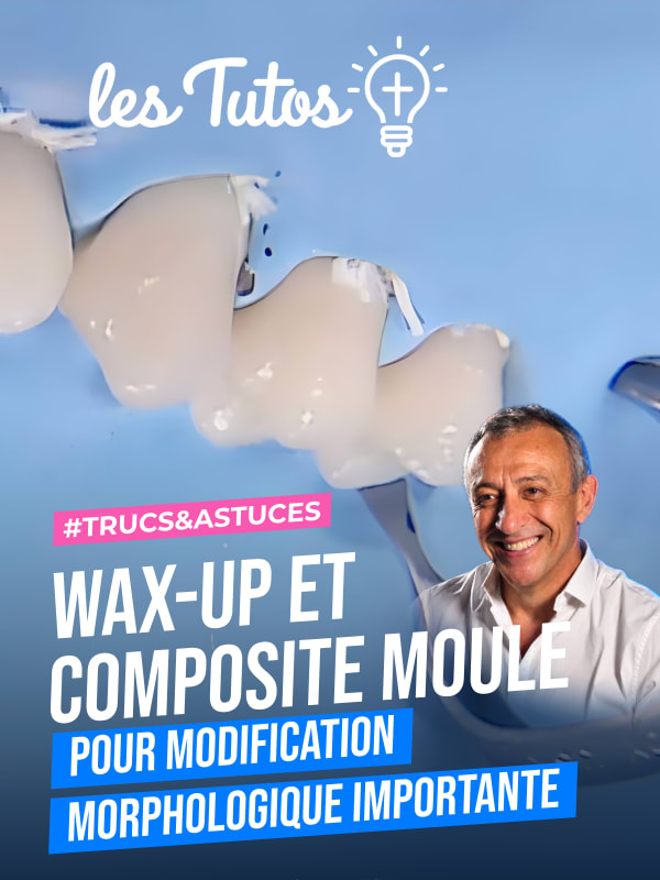 Wax-up et composite moule pour modification morphologique importante (Tuto, saison 1 épisode 5) : Restauration d'une canine en résine composite à…