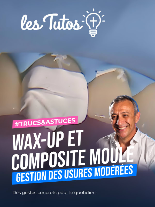 Wax-up et composite moule gestion des usures modérées (Tuto, saison 1 épisode 6) : Restauration de bords libres usés à l'aide de composite moulé