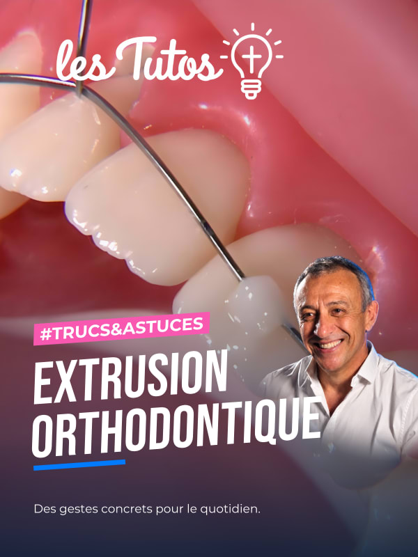 Extrusion orthodontique (Tuto, saison 1 épisode 8) : Utilisation de fil d'orthodontie pour permettre l'extrusion d'une incisive latérale