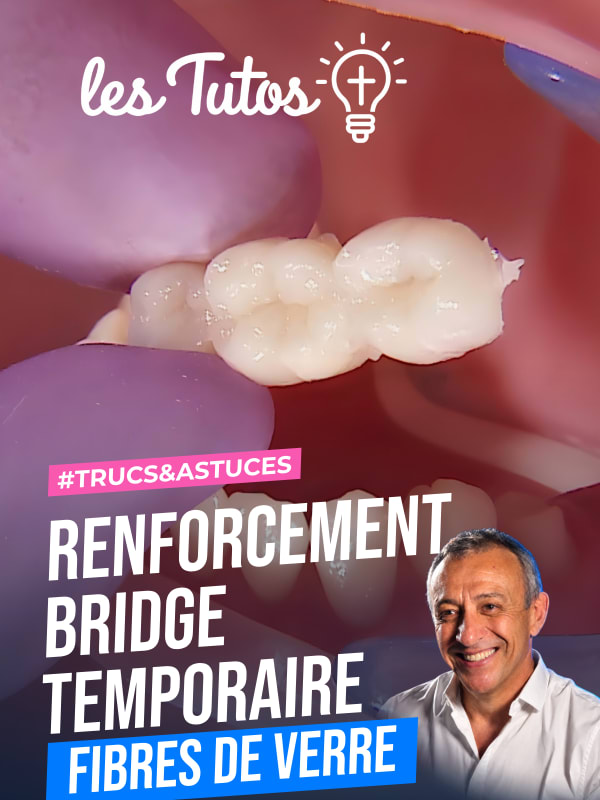 Renforcement bridge temporaire fibres de verre (Tuto, saison 1 épisode 9) : Renforcement d'un bridge provisoire avec fibre de verre dans le secteur…