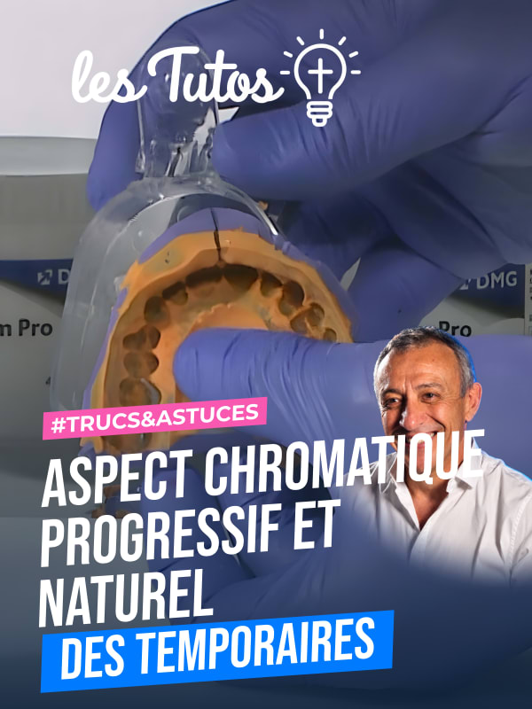 Aspect chromatique progressif et naturel des temporaires (Tuto, saison 1 épisode 10) : Reproduction de la chromaticité naturelle des dents dans le…