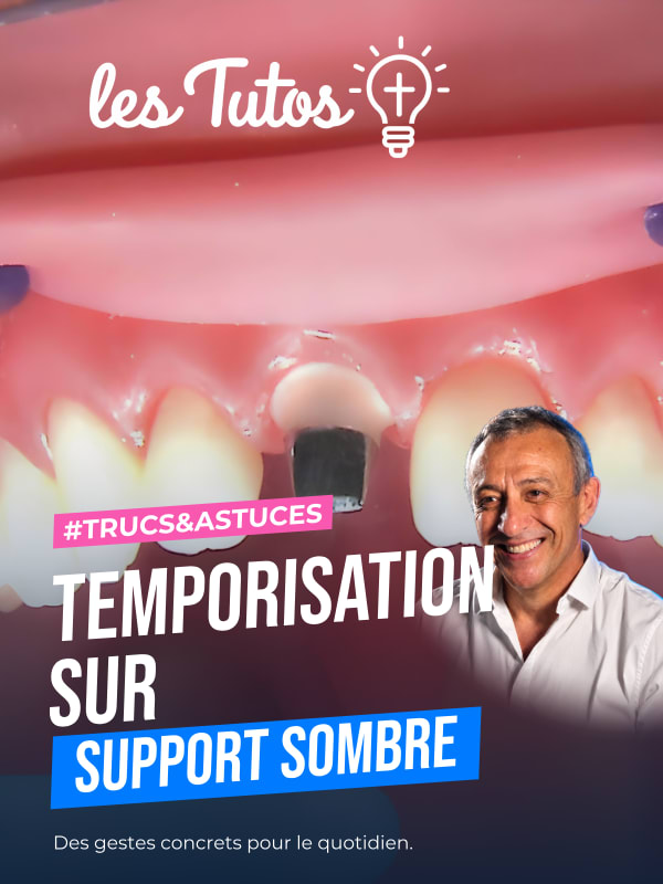 Temporisation sur support sombre (Tuto, saison 1 épisode 12) : Réalisation de provisoire en résine composite sur support métallique