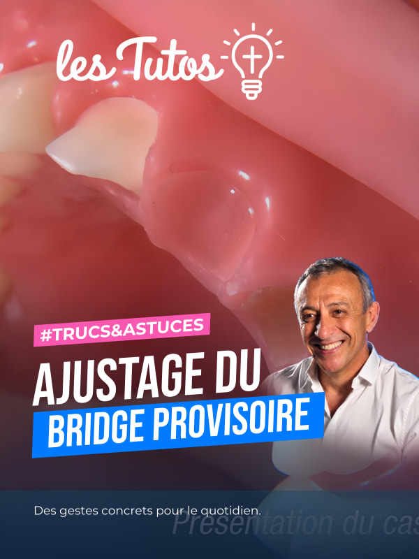 Ajustage du bridge provisoire (Tuto, saison 1 épisode 13) : Le Dr Jean Richelme explique l'ajustage précis d'un bridge provisoire dans cette vidéo…