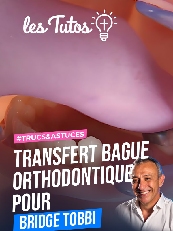 Transfert bague orthodontique pour bridge tobbi (Tuto, saison 1 épisode 15) : Transfert de bague orthodontique pour bridge TOBBI