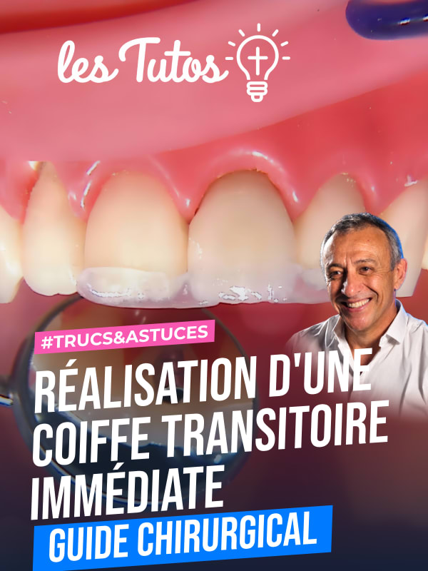 Réalisation d'une coiffe transitoire immédiate à l'aide du guide chirurgical (Tuto, saison 1 épisode 16) : Étapes de réalisation d'une coiffe…