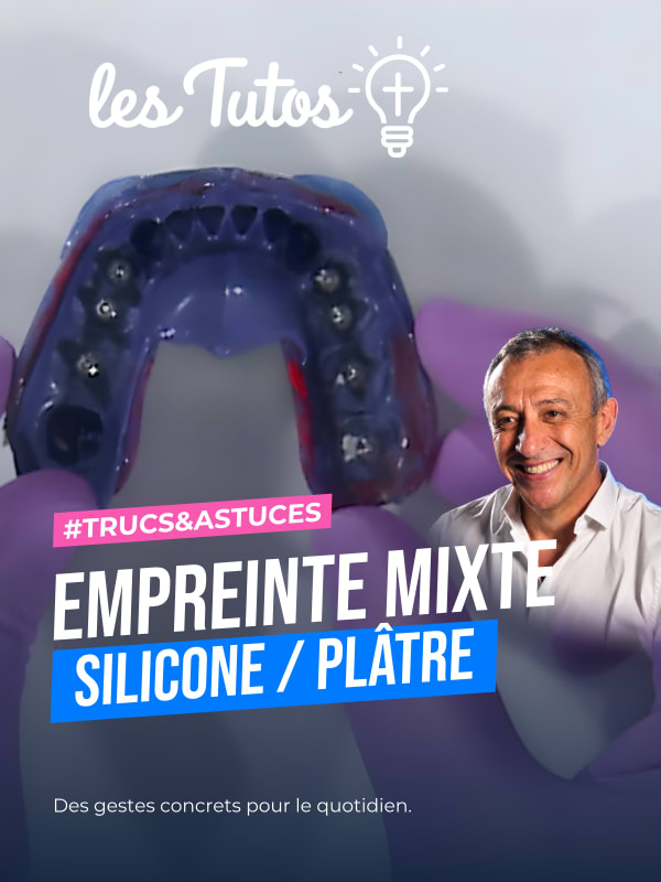 Empreinte mixte silicone / plâtre (Tuto, saison 1 épisode 17) : Empreinte mixte en réhabilitation implantaire